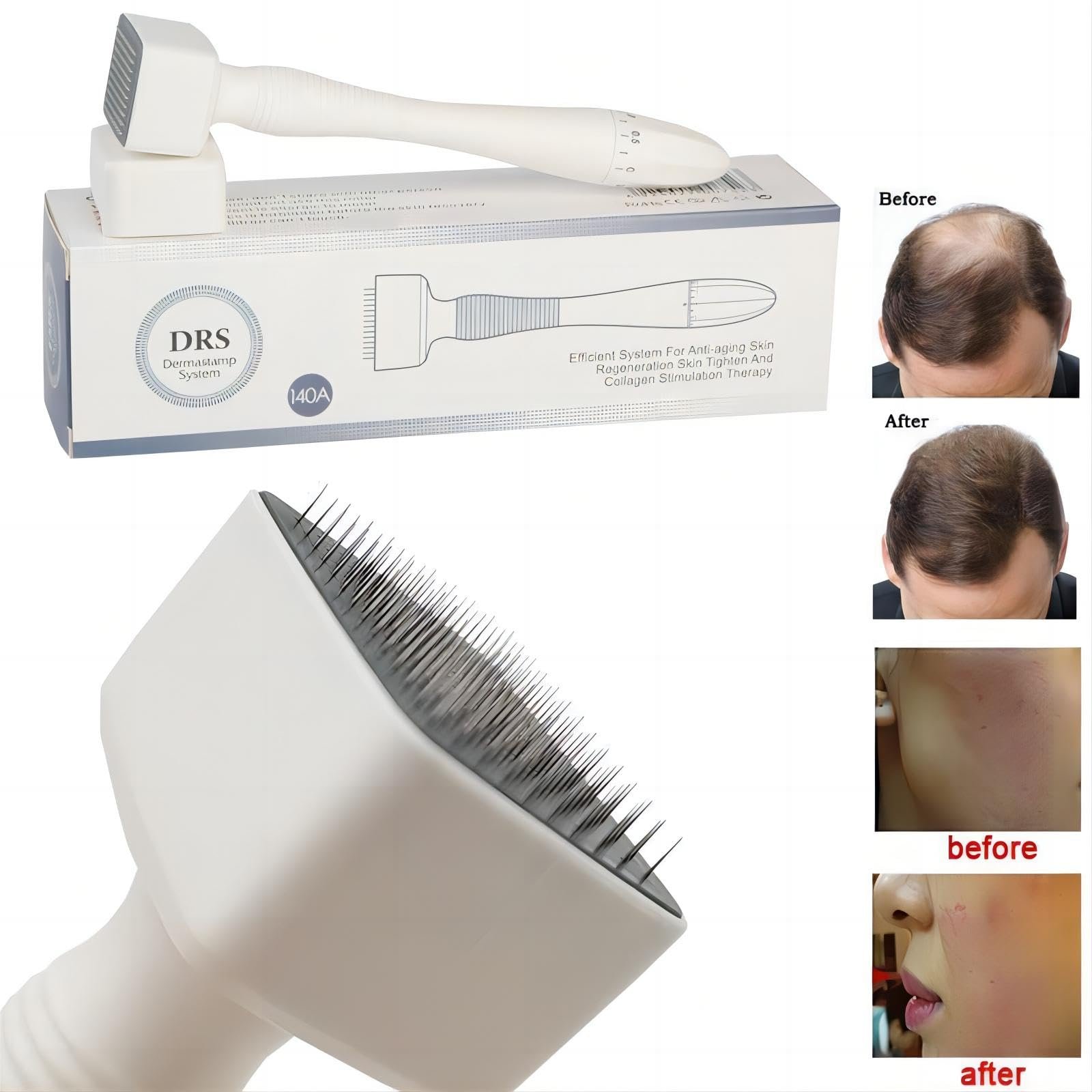 Adjustable 140 Pins Derma Roller Stamp Micro Needle Anti Wrinkle Skin Therapy ORIGINAL TITANIUM NEEDLE Original Product - Image 6